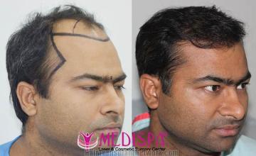 Hair restoration procedure before and after results