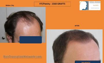 Hair transplantation surgery before and after photos