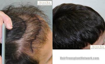 Hair transplantation surgery before and after images