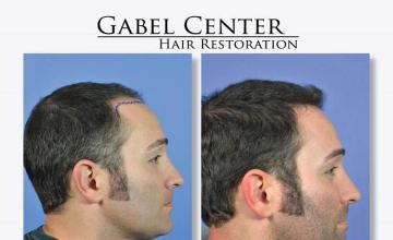 Before and after hair transplant procedure images