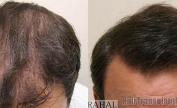 Hair restoration procedure before and after results