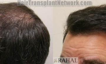 Hair transplantation surgery before and after images