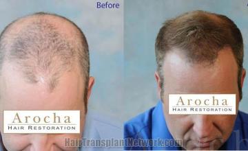 Hair restoration procedure before and after results