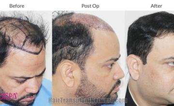 Hair transplantation procedure before and after results