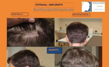 Hair transplantation surgery before and after images