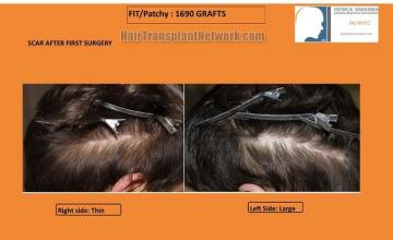 Hair transplantation surgery before and after pictures