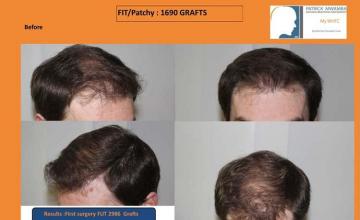 Hair transplantation surgery before and after photos