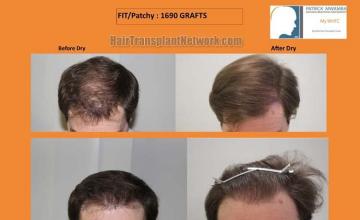 Hair transplantation surgery before and after pictures