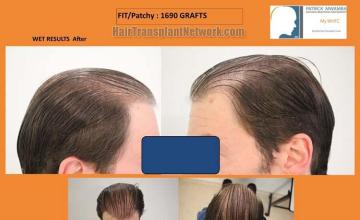 Hair transplantation surgery before and after photos