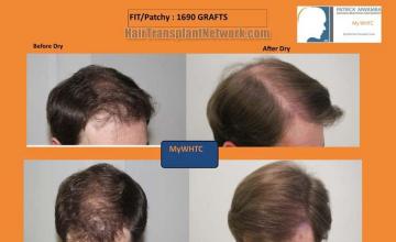 Hair restoration procedure before and after results