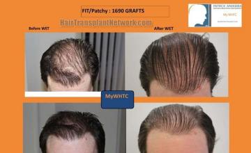 Hair transplantation surgery before and after images