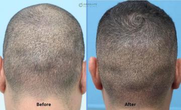 Hair replacement surgery before and after images