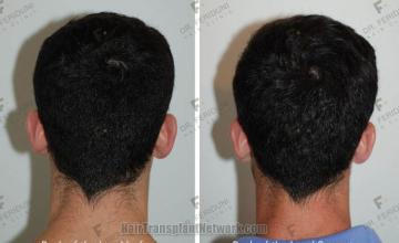 Hair replacement surgery before and after images