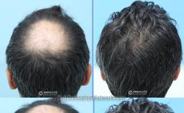 Surgical hair transplantation result photographs