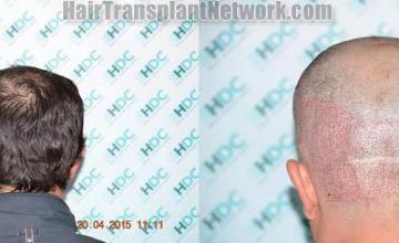 Hair transplantation surgery before and after pictures