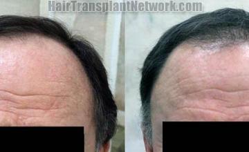 Hair restoration procedure before and after results