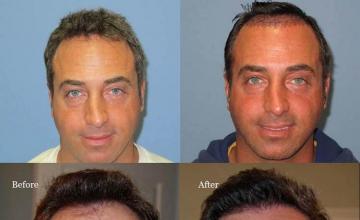 Hair restoration procedure before and after results