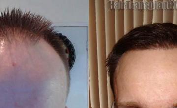Front view - Before and after 