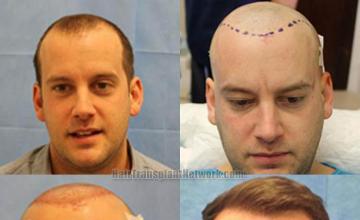 Hair transplantation surgery before and after photos