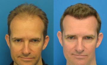 Hair restoration procedure before and after results