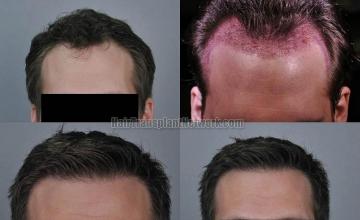 Hair transplantation surgery before and after photos