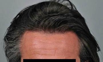 Front view - Before and after hair restoration surgery