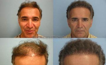 Hair transplantation surgery before and after photos