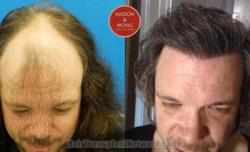 Hair restoration procedure before and after results