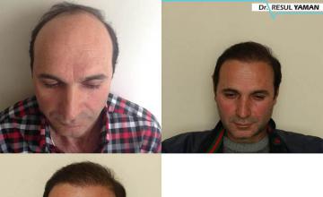 Hair transplantation surgery before and after pictures