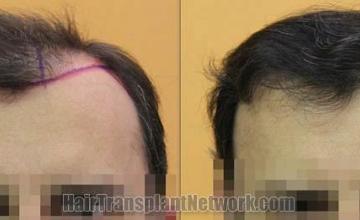 Before and after hair transplant procedure images