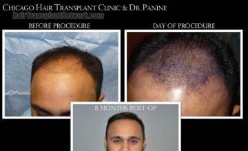 Hair restoration procedure before and after results