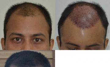 Before and after hair transplant procedure images