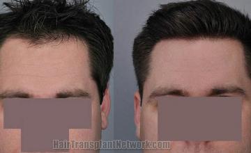 Before and after hair transplant procedure images