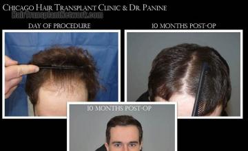 Hair restoration procedure before and after results