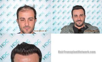 Before and after hair transplant procedure images