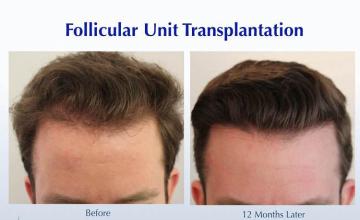 Hair restoration procedure before and after results