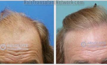 Front view - Before and after hair transplantation surgery