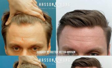 Front view - Before and after hair restoration procedure