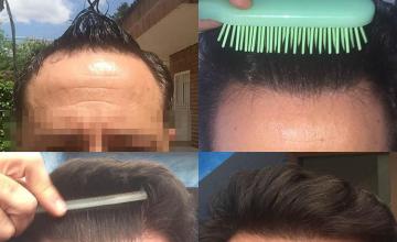 Before and after hair restoration procedure images