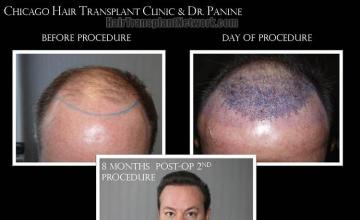 Front view - Before and after hair restoration procedure