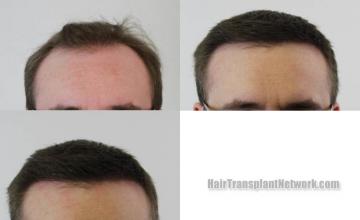 Before and after hair restoration procedure images