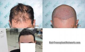 Front view - Before and after hair restoration procedure