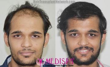 Front view - Before and after hair restoration procedure