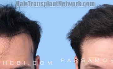 Front view - Before and after hair restoration procedure