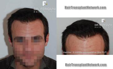 Hair restoration surgery before and after photos