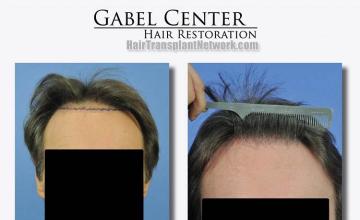 Before and after hair transplant procedure images