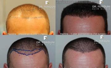 Hair restoration procedure before and after results