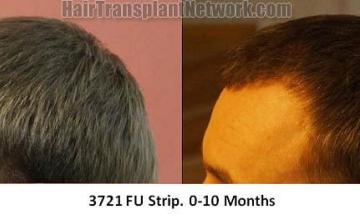 Hair transplantation surgery before and after images