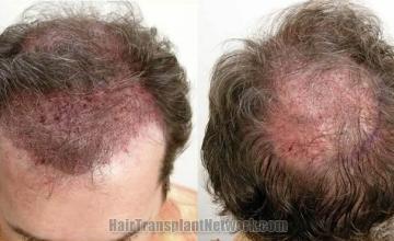 Immediate postoperative hair transplant photos