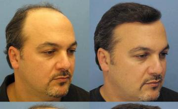 Right view - Before and after hair restoration procedure